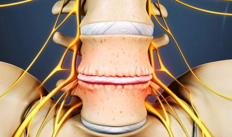 Un tercio de las personas entre 40 y 59 años tendría degeneración discal intervertebral