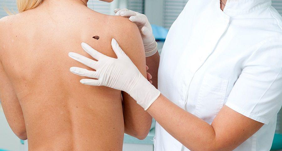 El melanoma es la forma más agresiva del cáncer de piel