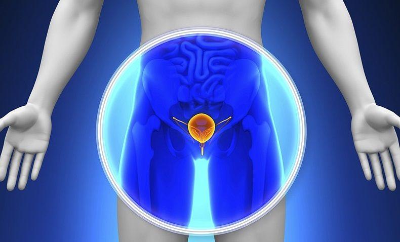 El cáncer de próstata más resistente se cronifica