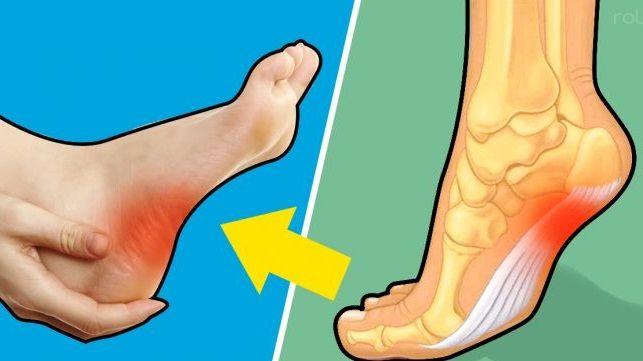 Running: ¿qué es la fascitis plantar o el “dolor de talón”
