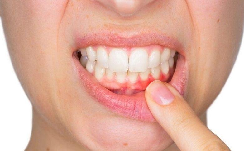 Estudio relaciona la periodontitis y la hipertensión