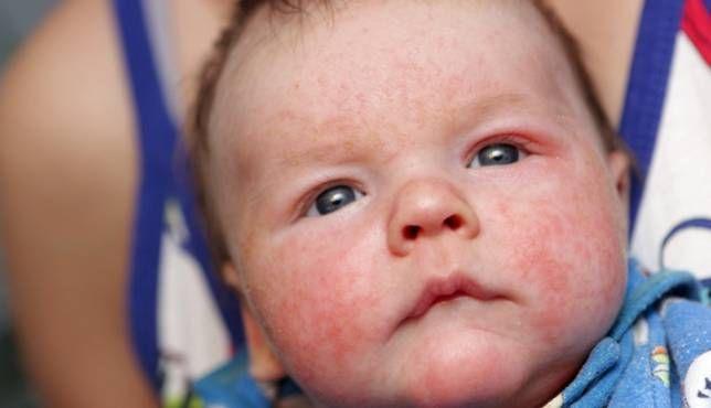 San Isidro: Taller gratuito sobre dermatitis atópica en niños