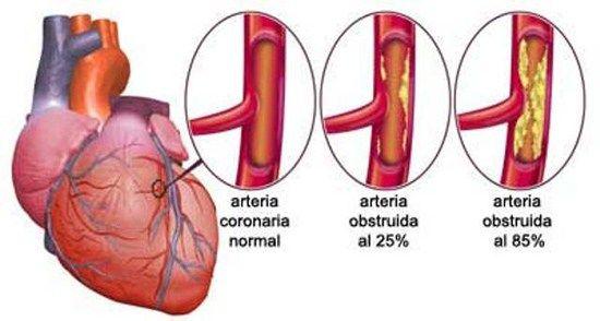 Isquemia miocárdica: Síntomas, causas, factores de riesgo, prevención y tratamiento