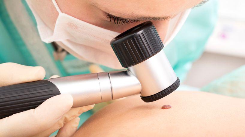 Melanoma: aprueban en Argentina nueva indicación para una combinación de drogas