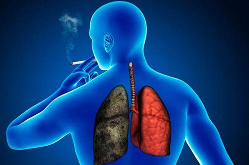 El cannabis tampoco es beneficioso en la EPOC