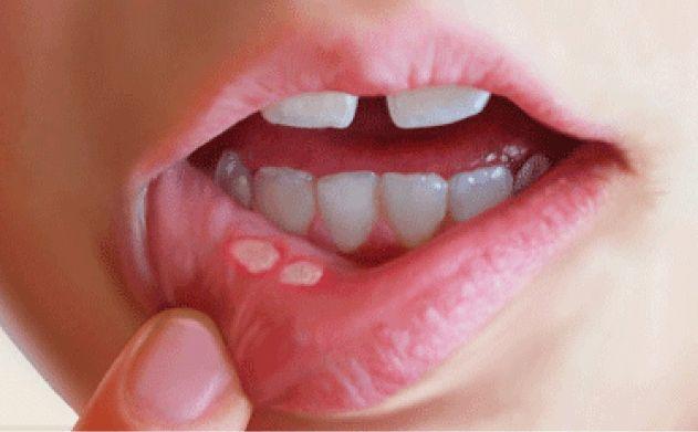 Aftas bucales: Qué son, síntomas, prevención y tratamiento
