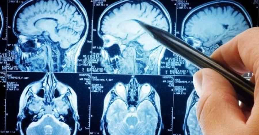 Está disponible en Argentina una nueva droga para tratar la esclerosis múltiple