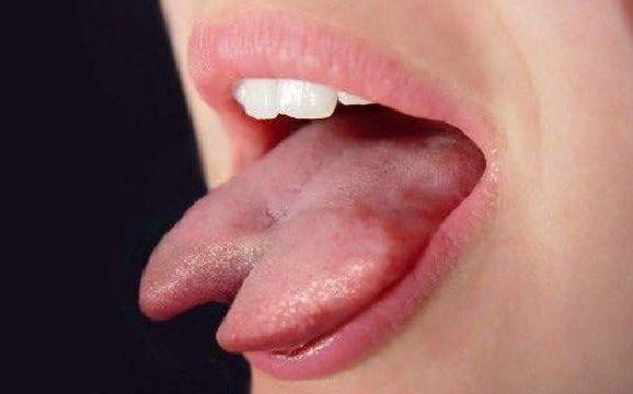 Lengua bífida: Los riesgos para la salud de la peligrosa moda de cortarse la lengua