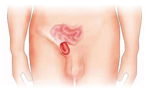 Hernia inguinal: Qué es, síntomas, causas, factores de riesgo y prevención