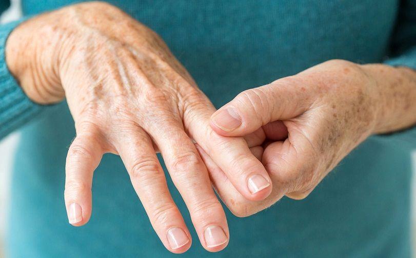 Artritis reumatoide: Qué es, síntomas, diagnóstico y tratamiento