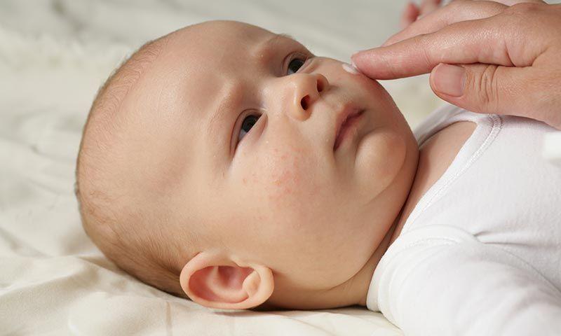San Isidro: especialistas advierten sobre los síntomas de la dermatitis atópica