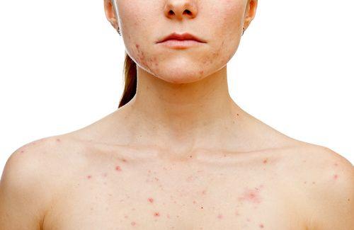 Más de la mitad de los pacientes con dermatitis intenta ocultarlo