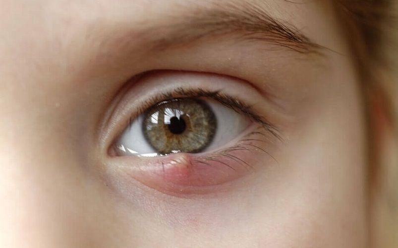 Orzuelo: Qué es, síntomas, causas, prevención y tratamiento