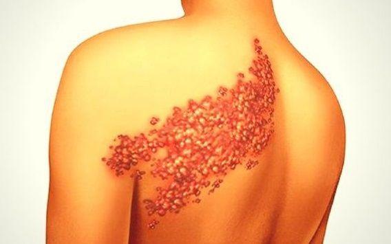 Culebrilla: Qué es, síntomas, causas, diagnóstico, prevención y tratamiento