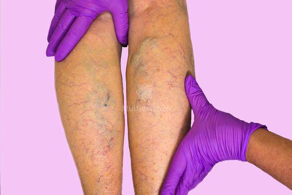 A mayor estatura mayor riesgo de varices