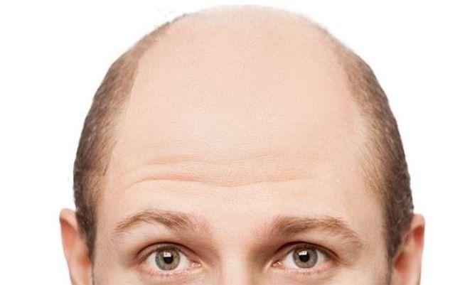 Fármaco para la dermatitis atópica hace crecer el pelo en caso de alopecia severa