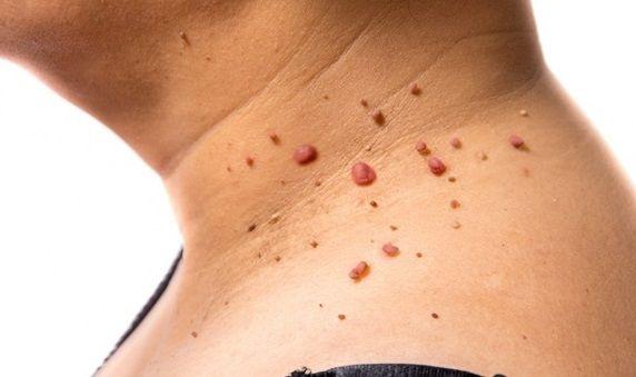 Verrugas: qué son, causas, diagnóstico, prevención y tratamiento