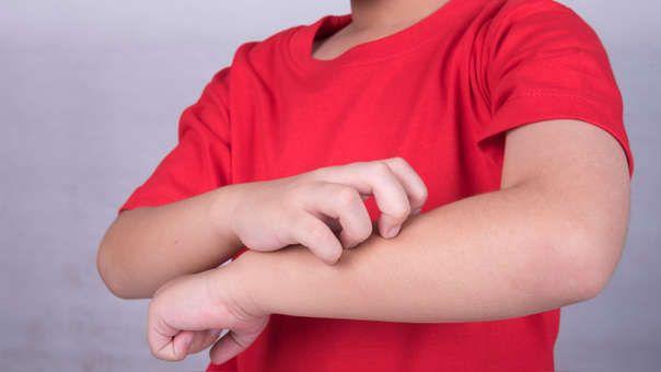 San Isidro: Especialistas concientizan sobre dermatitis atópica