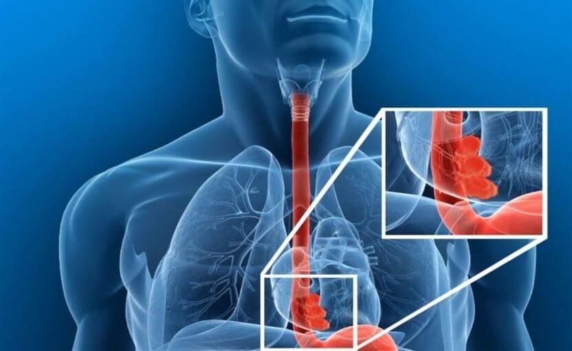 El tabaco y el alcohol incrementan el riesgo de desarrollar cáncer de esófago