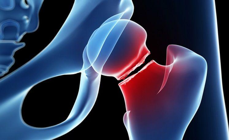 Fractura de cadera: Qué es, causas, prevención y tratamiento