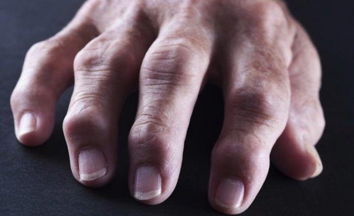 Artritis reumatoide: qué es, síntomas, diagnóstico y tratamiento