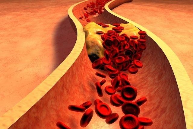 Triglicéridos altos en sangre: qué producen y cómo disminuir los valores