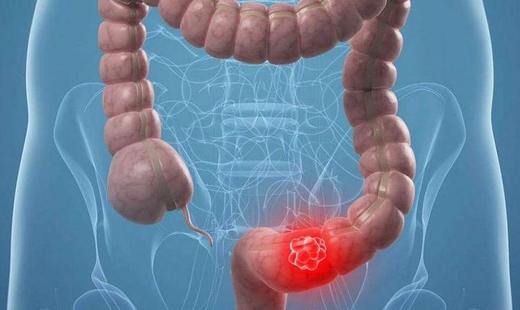 Una dieta alta en grasas favorece el crecimiento del cáncer colorrectal