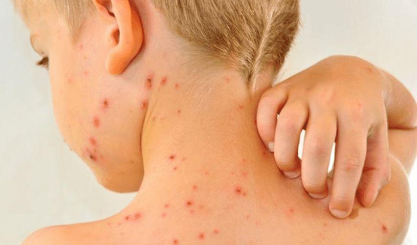 Unicef, alarmada por resurgimiento del sarampión en el mundo