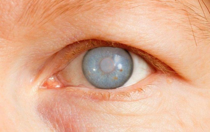 El glaucoma, una enfermedad silente que puede conducir a la ceguera