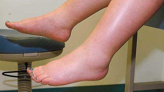 Linfedema: Qué es, síntomas, causas, factores de riesgo y prevención