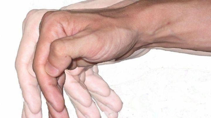 Parkinson: aún no hay fármacos curativos pero sí terapias que mejoran los síntomas motores