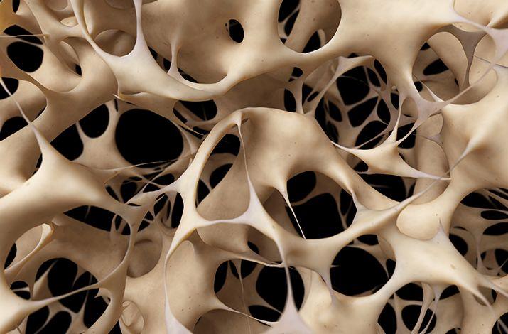 En EEUU aprueban nuevo medicamento para combatir la osteoporosis