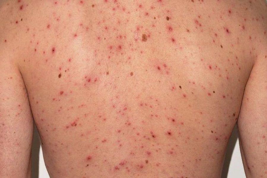 Alerta epidemiológica por un caso confirmado de sarampión en Rosario