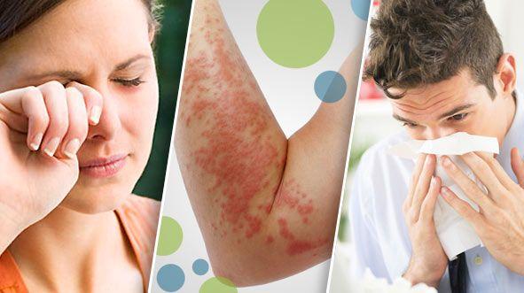 Alertan que en el 2050 la mitad de la población mundial padecerá algún tipo de alergia