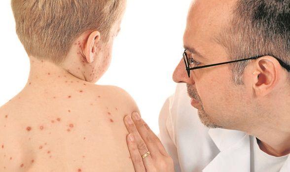 En EEUU alertan de que el sarampión podría resurgir con toda su fuerza