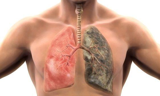 El cáncer de pulmón aumenta en no fumadores por el efecto de la polución y el tabaquismo pasivo
