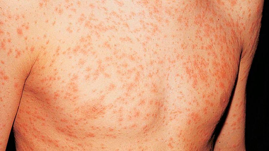 Córdoba: alerta epidemiológico por un caso de rubéola