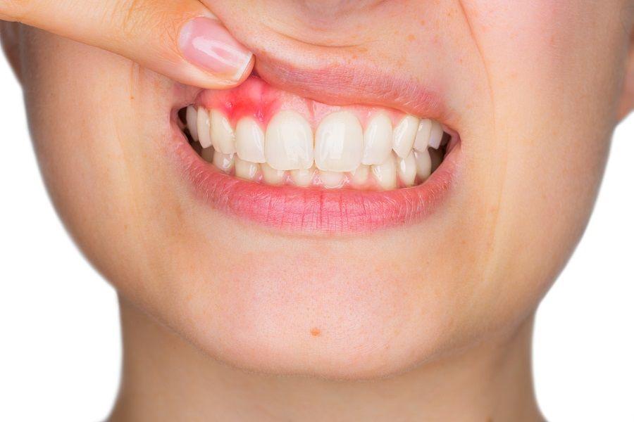 Gingivitis: qué es, síntomas, causas, complicaciones y prevención