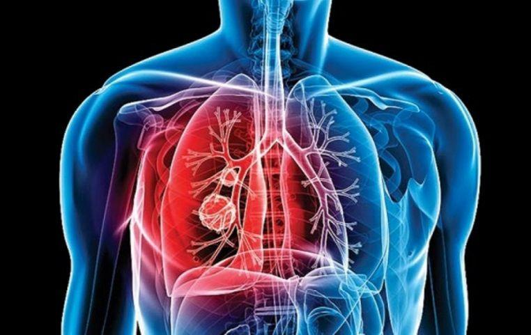 ANMAT aprobó un tratamiento que elimina los rastros de cáncer de pulmón en el 80% de los casos