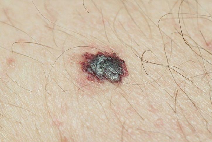 El cáncer de piel se cura y se previene