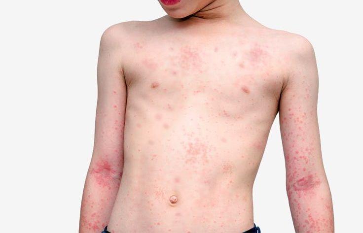 Emiten alerta epidemiológica tras confirmar un caso de rubéola en CABA