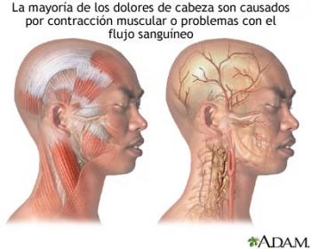 El dolor de cabeza
