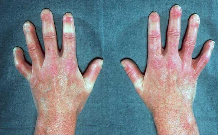 Consejos para personas con esclerodermia