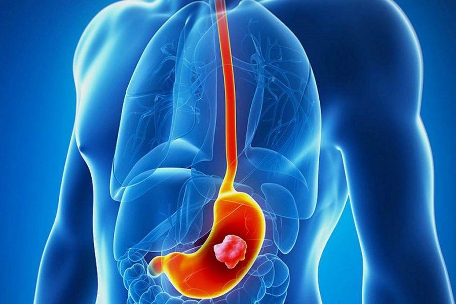 Identifican una mucosa que oculta el cáncer de estómago