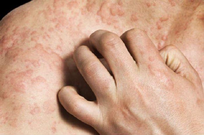 ¿Cómo saber si eres alérgico a la penicilina?