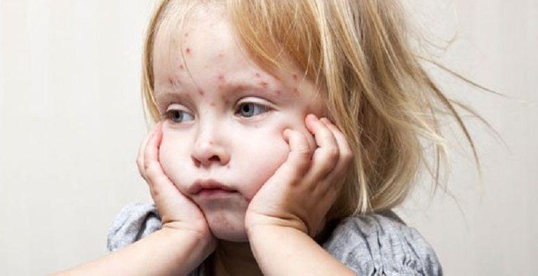 Enfermedades eruptivas: vacunarse es la mejor prevención