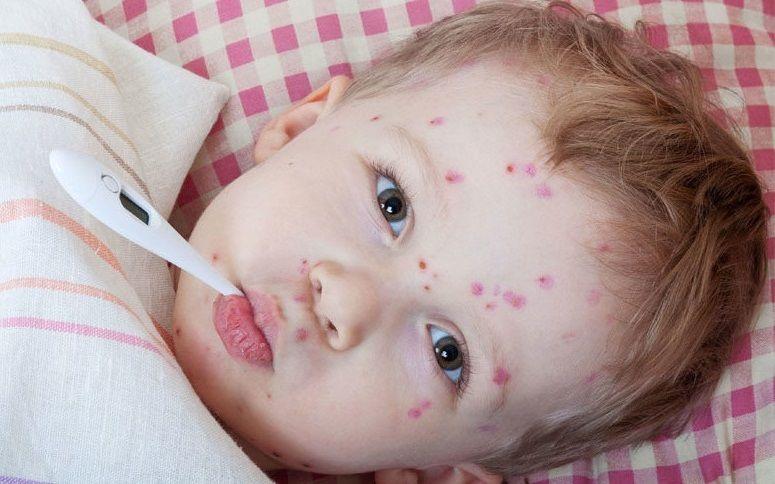 Califican de ¨dramático¨ el resurgimiento del sarampión en Europa