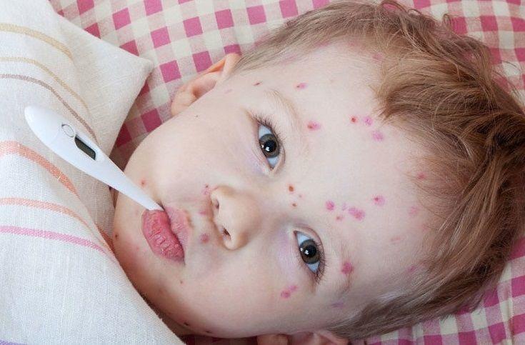 Sarampión: los bebés entre 6 y 11 meses deben recibir una dosis extra de vacuna triple viral