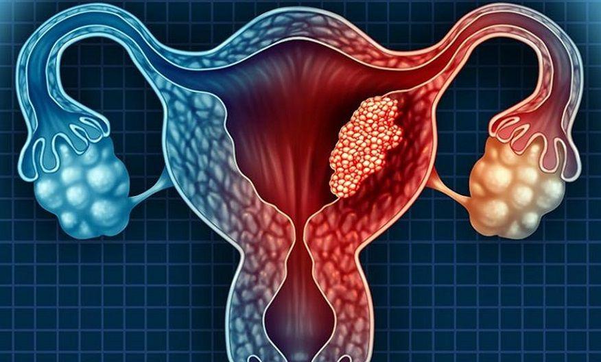 Cáncer de endometrio: síntomas, diagnóstico, factores de riesgo y tratamiento