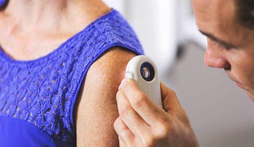 Melanoma: una campaña propone prevenir el tipo de cáncer de piel más agresivo